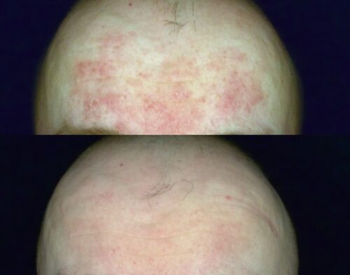 resultaat behandelen acné rosacea